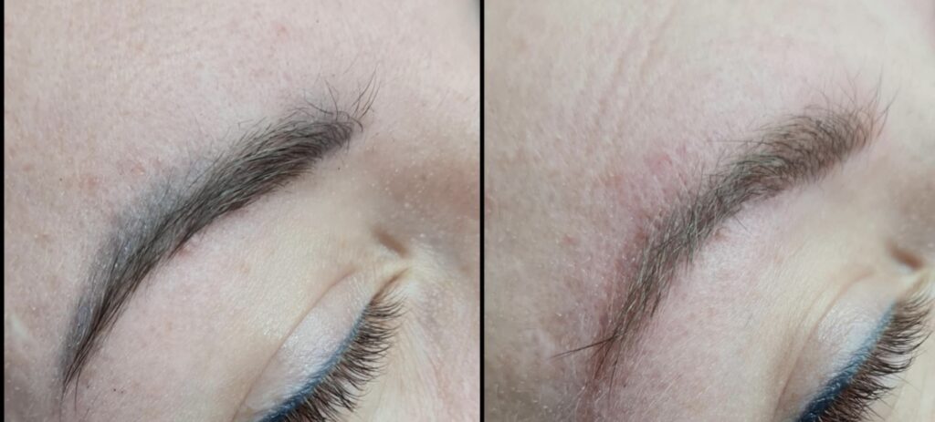 Efekt przed i po laserowym usuwaniu makijażu permanentnego brwi w Zophia Beauty Poznań