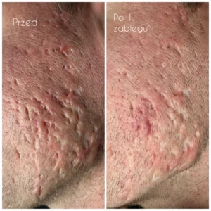 Terapia blizn Poznań - efekt przed i po skin needlingu na bliznach potrądzikowych