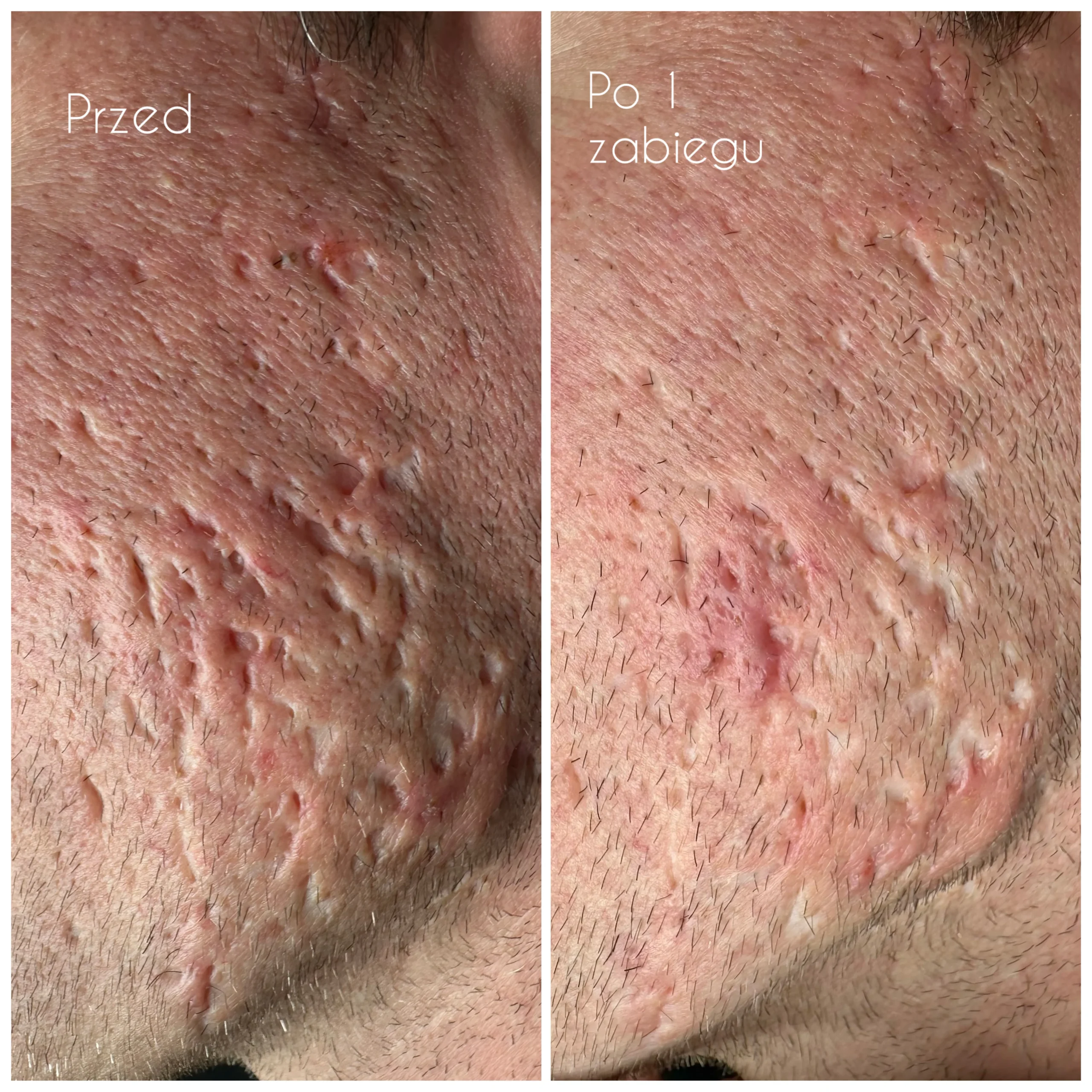 Terapia Blizn Poznań – Skin Needling, Podcinanie | Zophia Beauty
