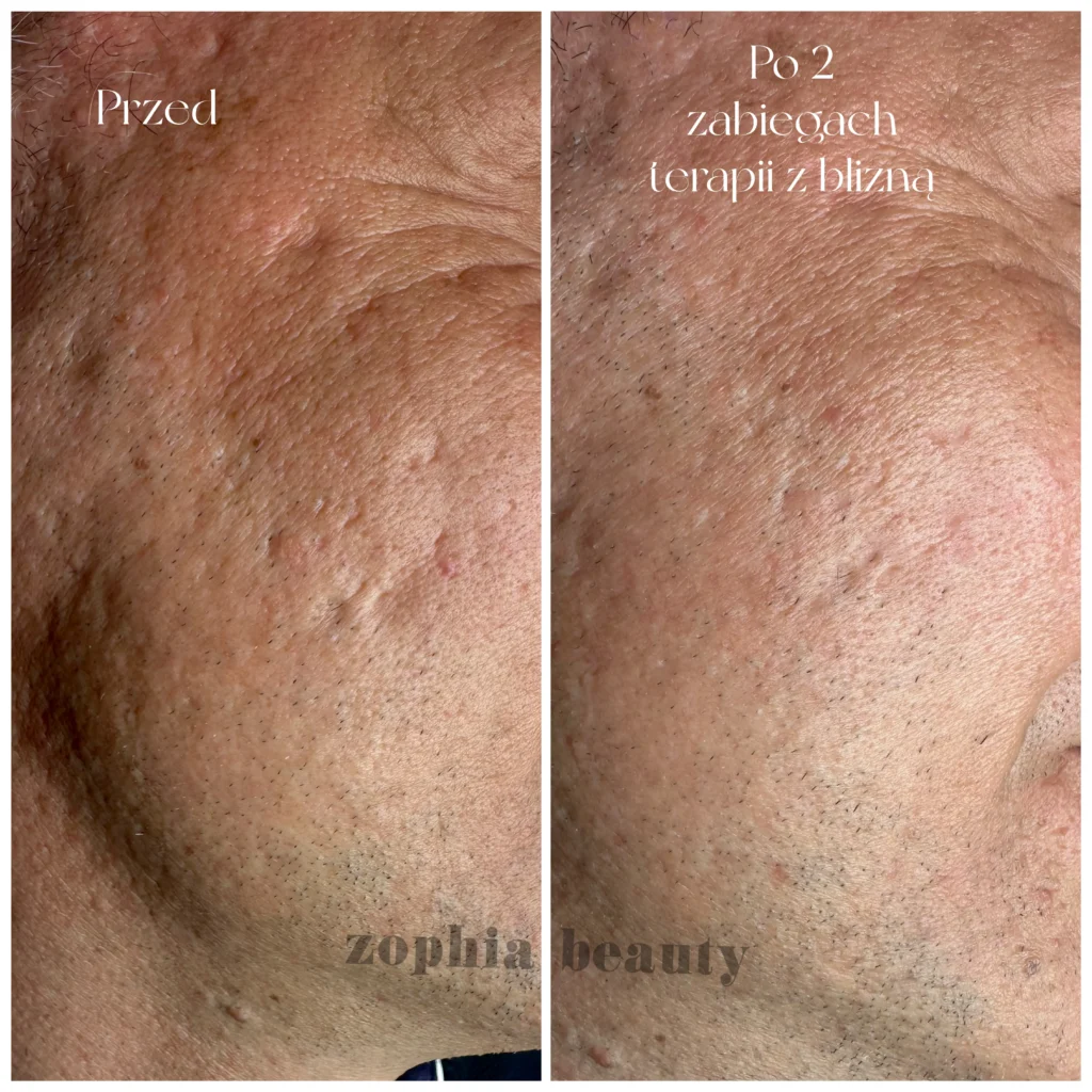 Zabieg skin needling na blizny potrądzikowe - ZophiaBeauty