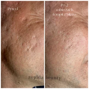Zabieg skin needling na blizny potrądzikowe - ZophiaBeauty